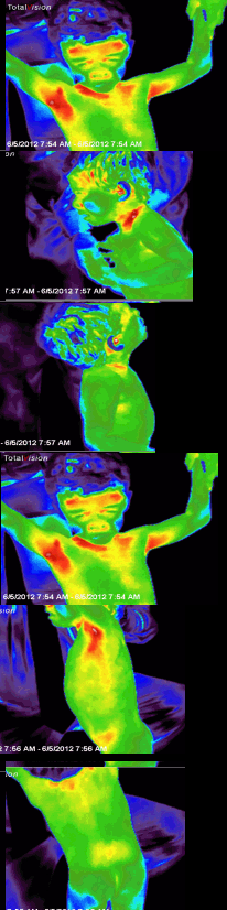 Thermal images after SWC water and cream 